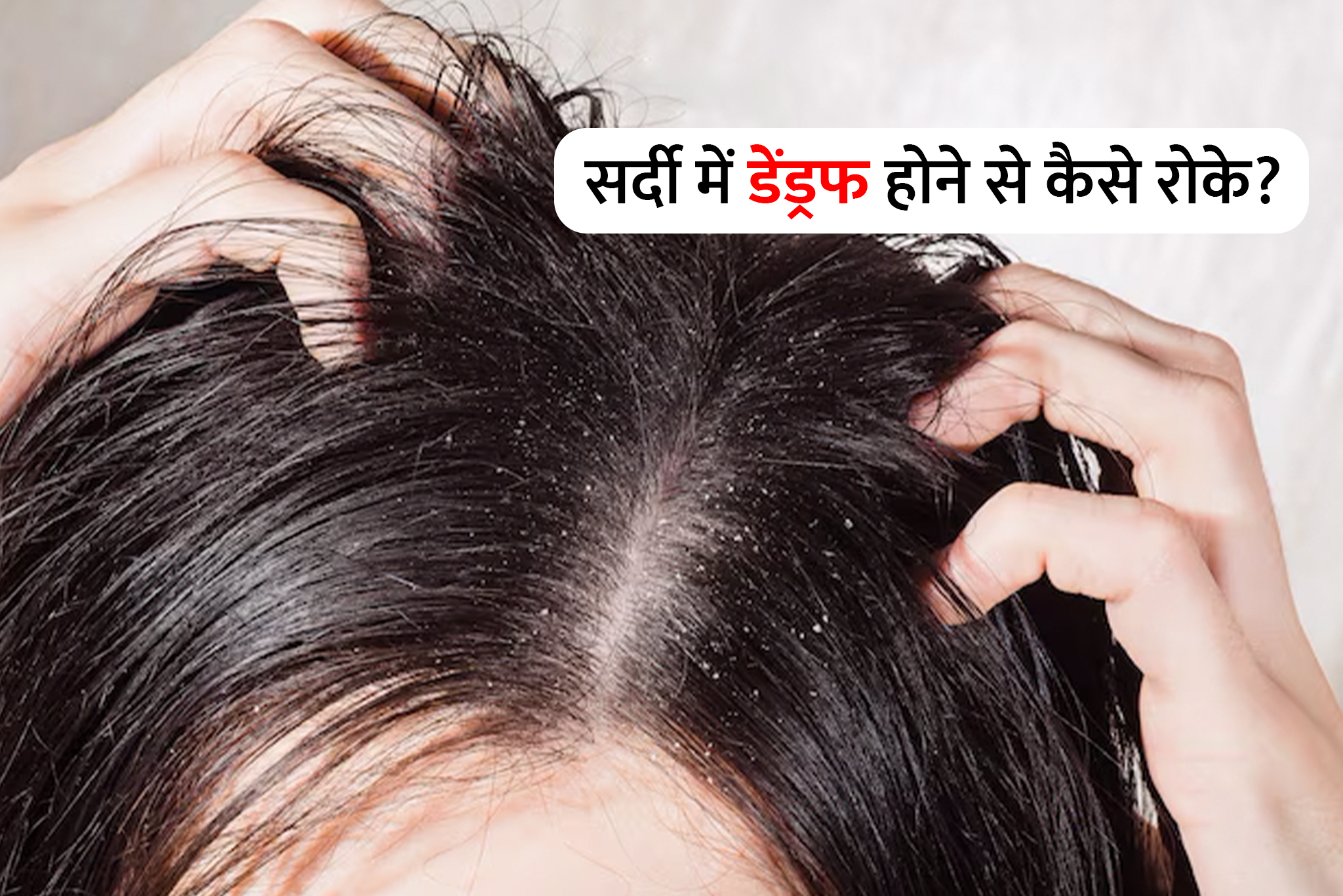 how to treat dandruff in winter